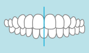 正中線　難波矯正歯科　裏側矯正