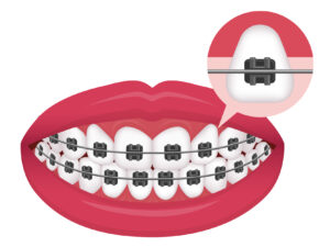 歯列矯正中の口のイラスト