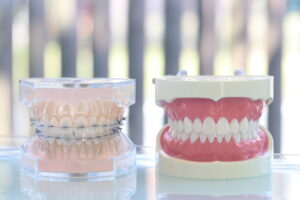 歯列矯正（表側矯正）の装置模型
