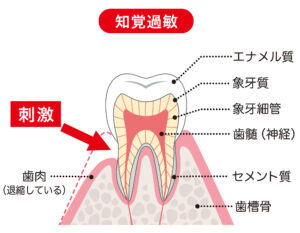 知覚過敏の歯の構造のイラスト