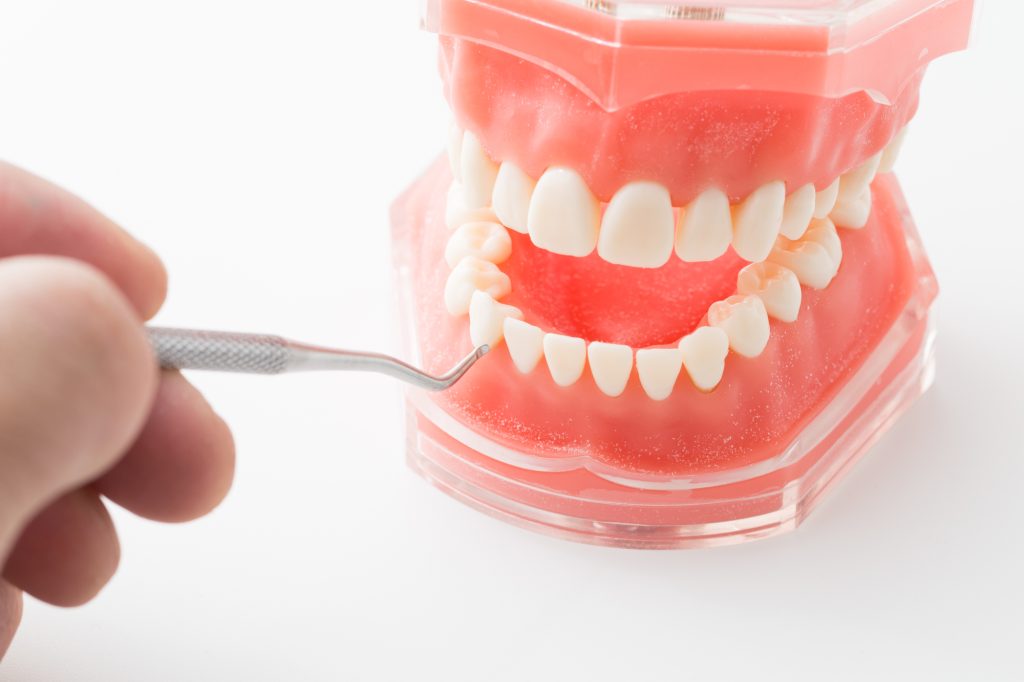 歯の模型,治療のイメージ