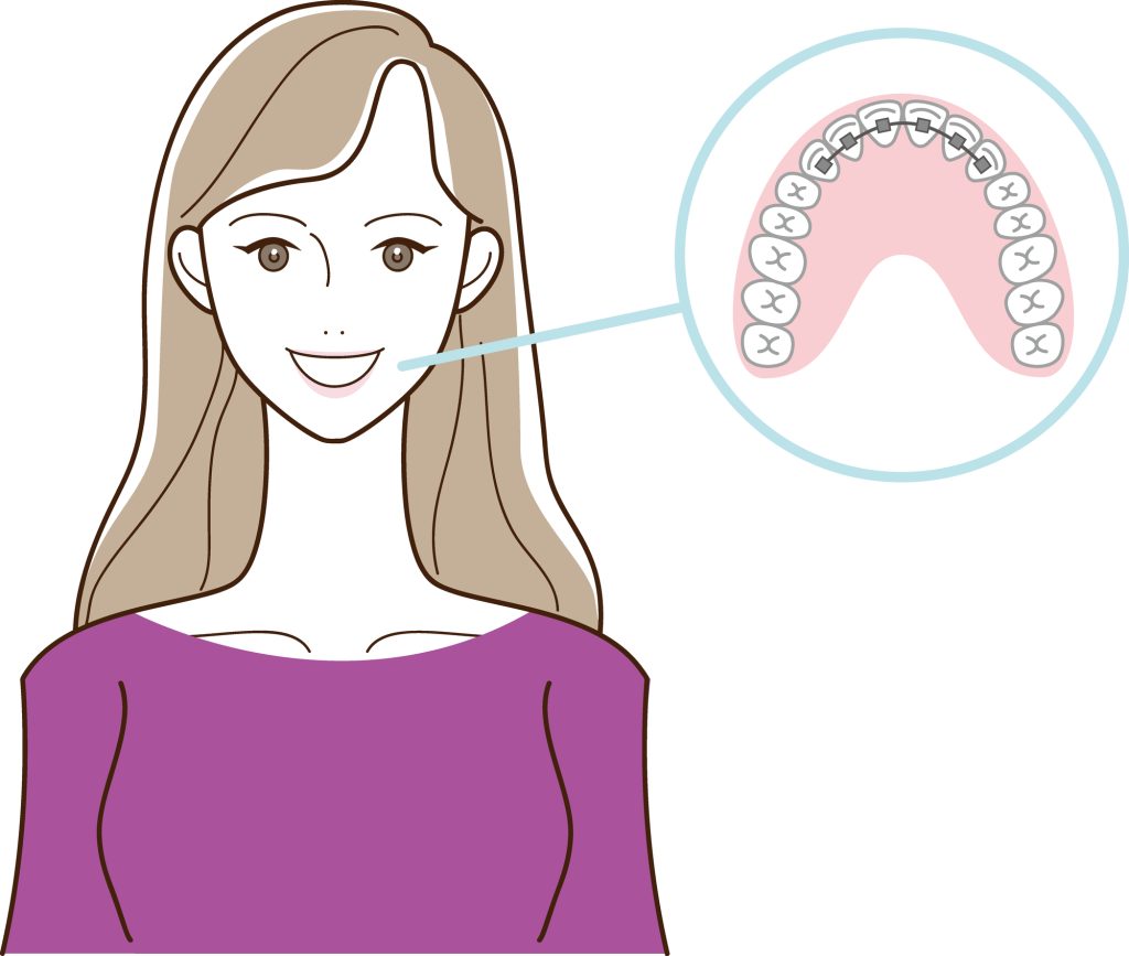 部分矯正で歯並びの治療をしている女性のイラスト