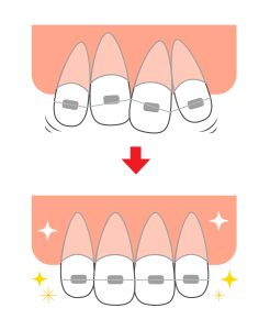 歯列矯正で歯が動くイメージのイラスト