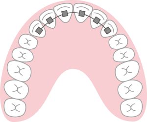 歯列矯正の部分矯正のイラスト
