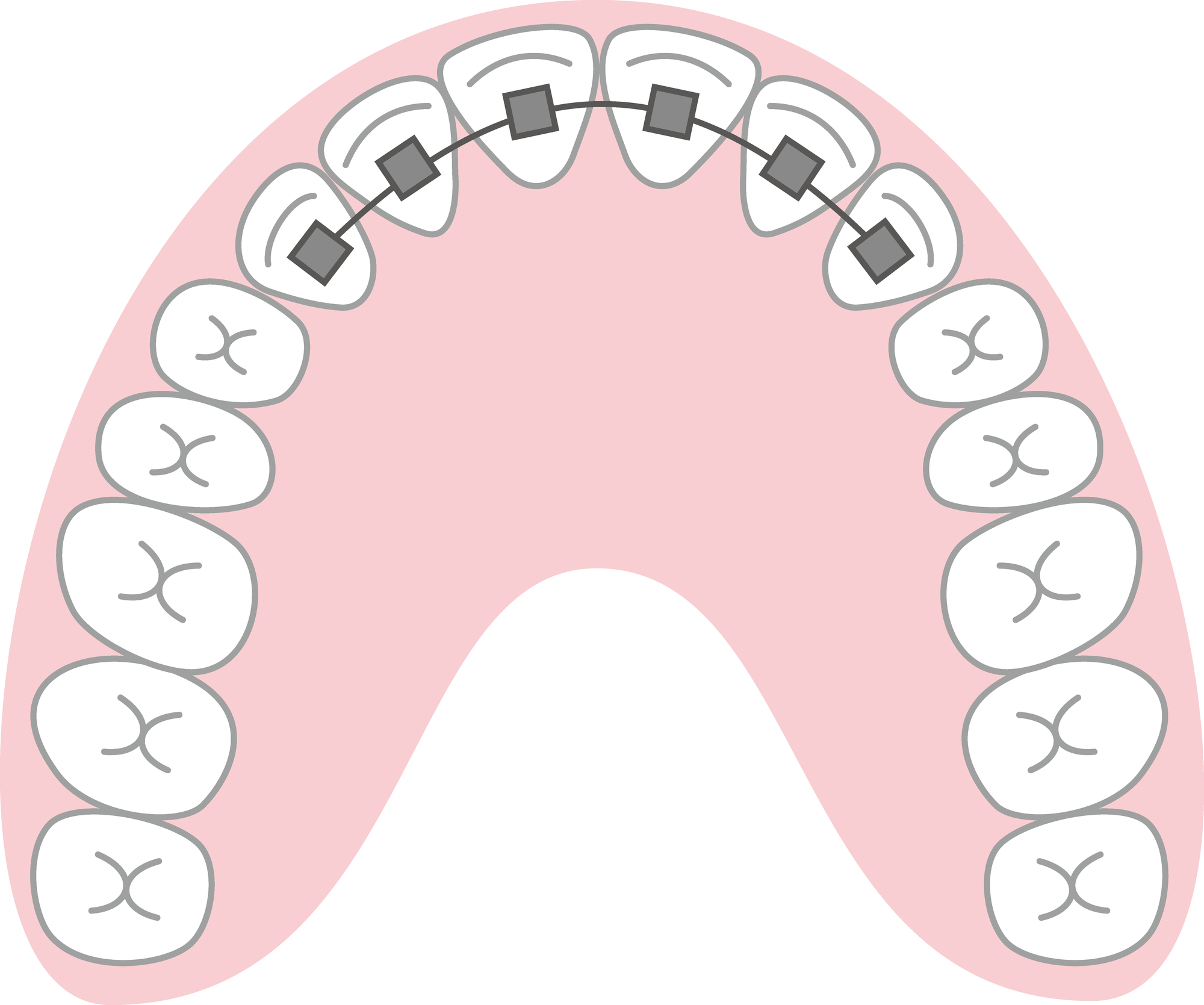 歯列矯正の部分矯正のイラスト