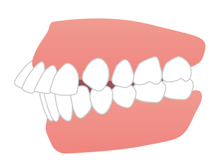 出っ歯の歯並びのイラスト