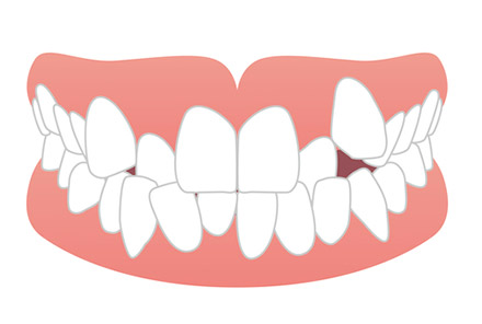 叢生（八重歯）の歯並びのイラスト