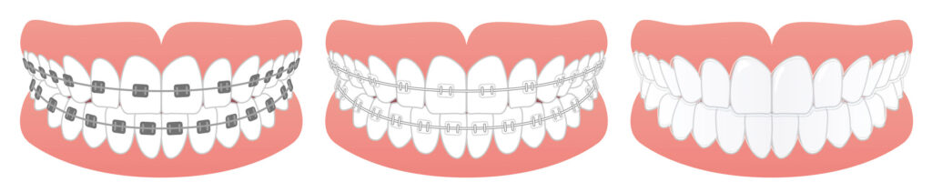 歯列矯正の治療法の種類のイラスト