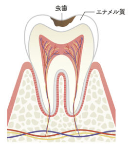 虫歯の図解イラスト