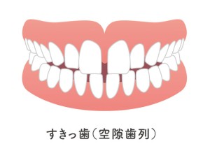 空隙歯列弓（すきっ歯）を治したい方へ | 舌側矯正専門クリニックは大阪難波の「難波矯正歯科」